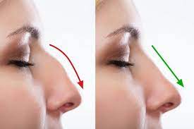 The Benefits of Choosing Ultrasonic Rhinoplasty for Nose Surgery in Dubai