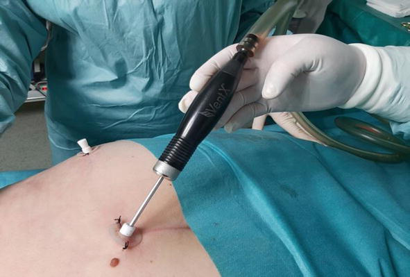 From Stubborn Fat to Sculpted Confidence: The Complete Truth About Vaser Liposuction Surgery in Dubai