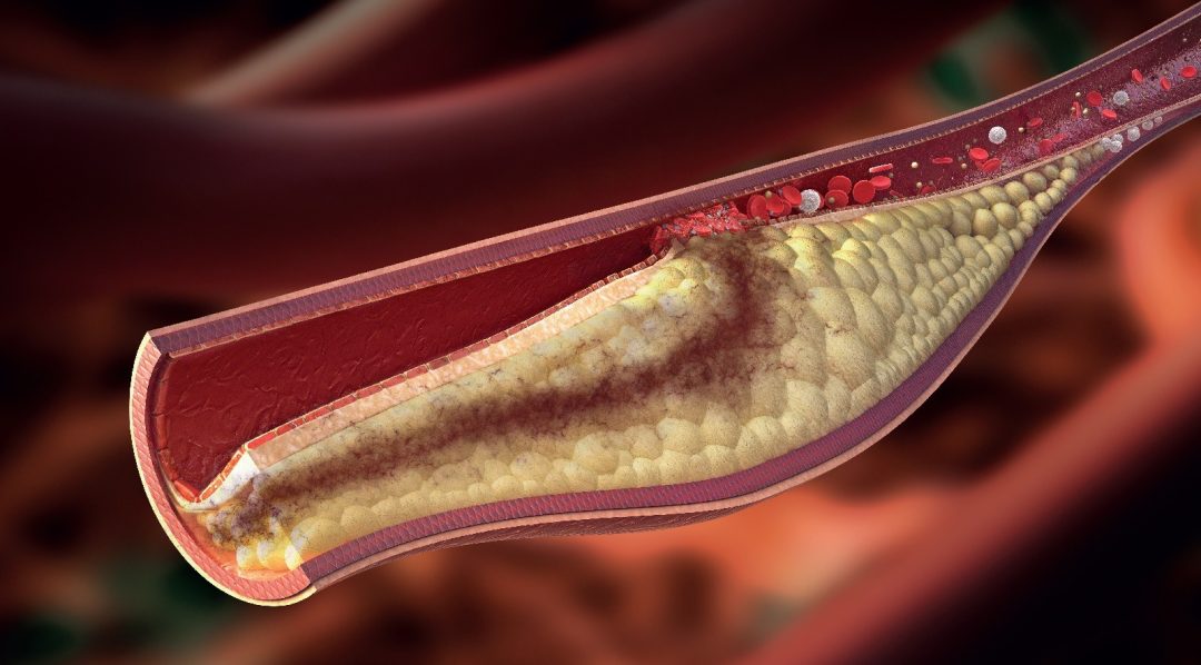 How Diet Affects High Cholesterolemia in Dubai